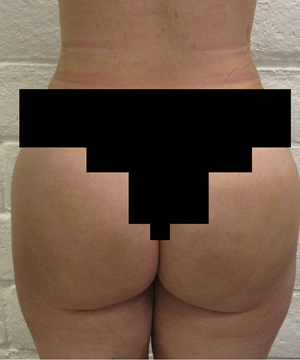 Brazilian Butt Lift for Thinner Patients