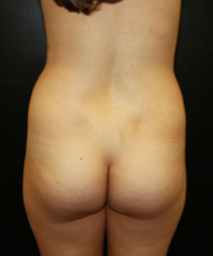 Brazilian Butt Lift for Thinner Patients