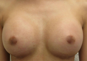 Breast Augmentation (Implants)