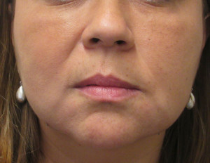 FaceTite