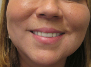 FaceTite