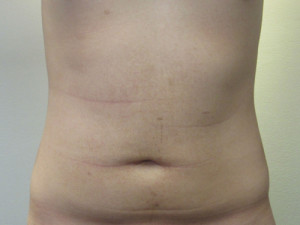 Abdomen
