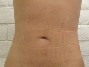 Abdomen