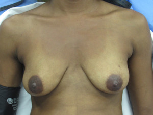 Breast Augmentation (Implants)