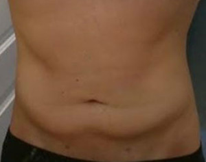 Abdomen