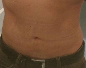 Abdomen