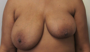 Breast Augmentation and Lift