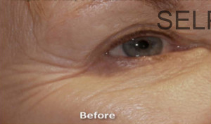 PRP for facial Rejuvenation