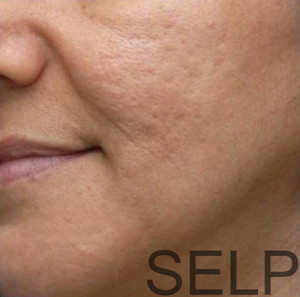 PRP for facial Rejuvenation