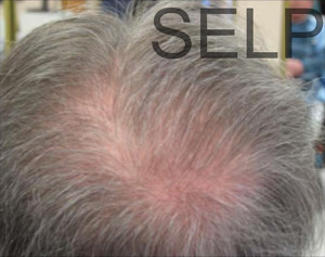 PRP for Hair Loss