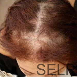 PRP for Hair Loss