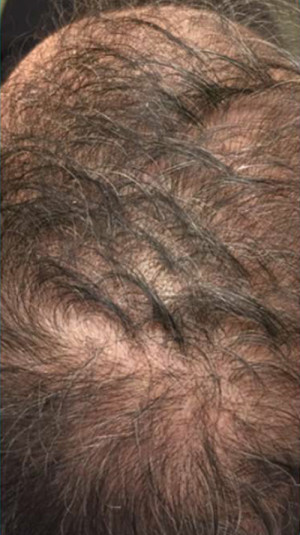 PRP for Hair Loss