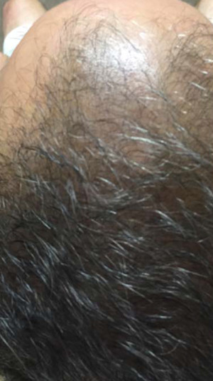 PRP for Hair Loss