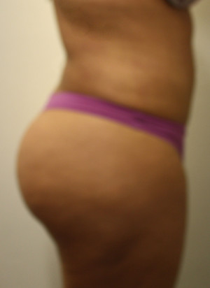 Brazilian Butt Lift