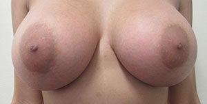 Breast Augmentation (Implants)