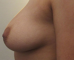 Breast Augmentation (Implants)