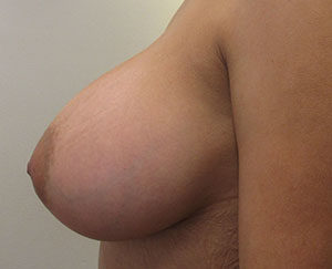 Breast Augmentation (Implants)