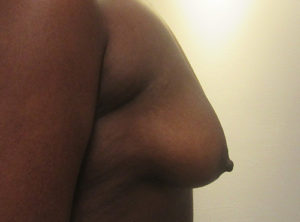 Breast Augmentation and Lift