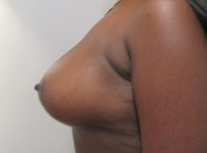Breast Augmentation and Lift