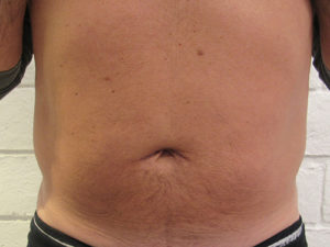 Liposuction Revision & Cellulite Reduction