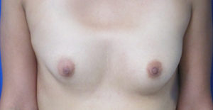 Breast Augmentation with Fat Grafting