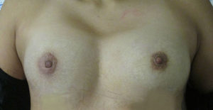 Breast Augmentation with Fat Grafting