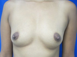 Breast Augmentation (Implants)
