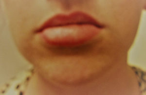 Silicone Injections & Biopolymer Removal