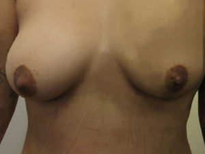 Breast Augmentation with Fat Grafting