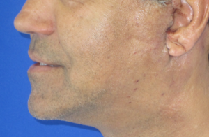 Facelift