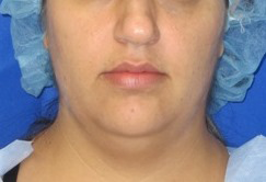 Neck Lift