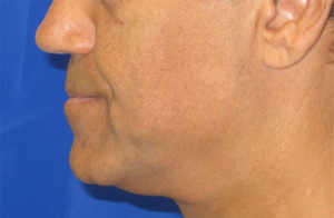 Facelift