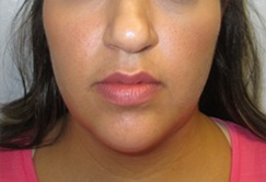 Neck Lift