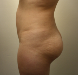 Butt Implants