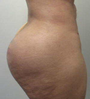 Butt Implants