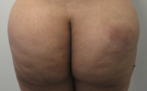 Butt Implants