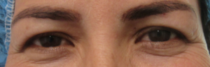 Eyelid Surgery