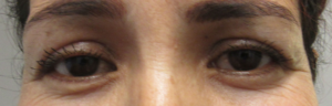 Eyelid Surgery