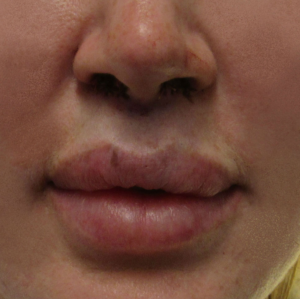Lip Lift