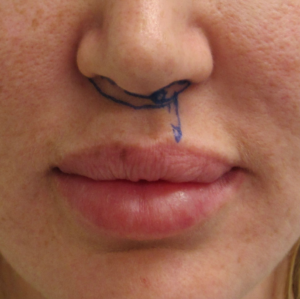 Lip Lift