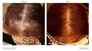 Platelet Rich Plasma or PRP for Hair Regrowth