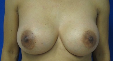 After Breast Fat Transfer and Implant Replacement