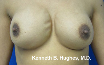Breast Fat Grafting to Improve Implant Rippling Before