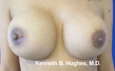 Breast Fat Grafting to Improve Implant Rippling After