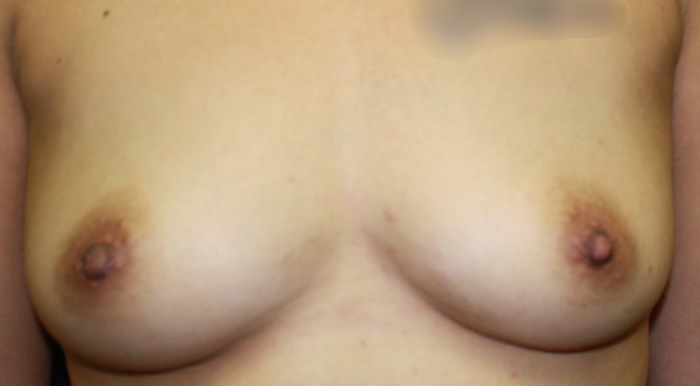Breast Fat Grafting Before