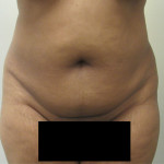 female abdomen before bodytite technology
