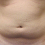 male abdomen before bodytite technology