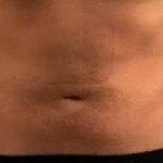 male abdomen after bodytite technology