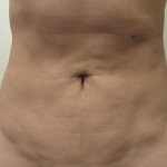 female abdomen before bodytite technology