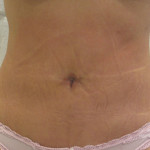 female abdomen after bodytite technology